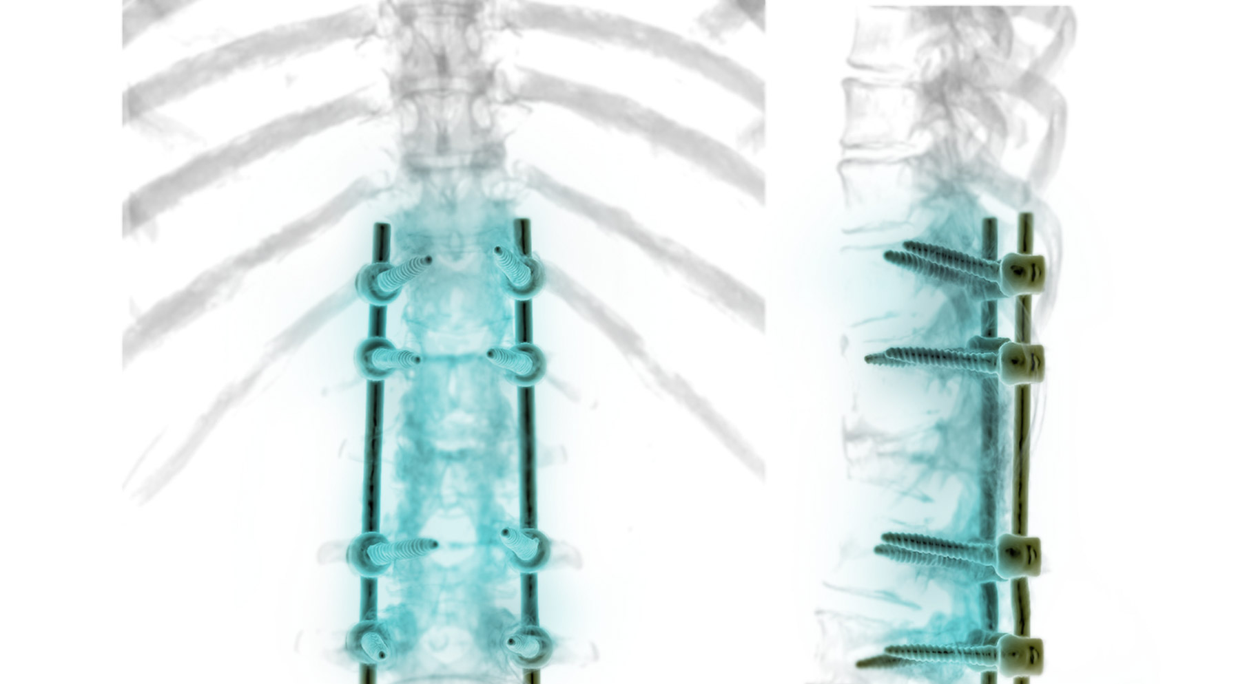 Spinal fusion illustration
