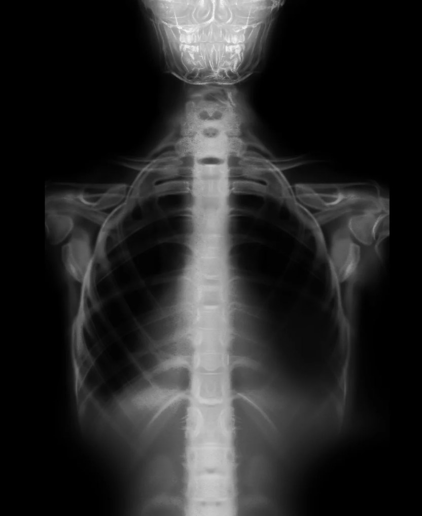 Spine x-ray imaging